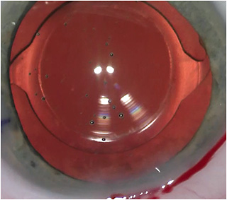 Figure 2. Quality centration of the optic and the capsulotomy minimizes long-term tilt or decentration problems with capsular contraction.