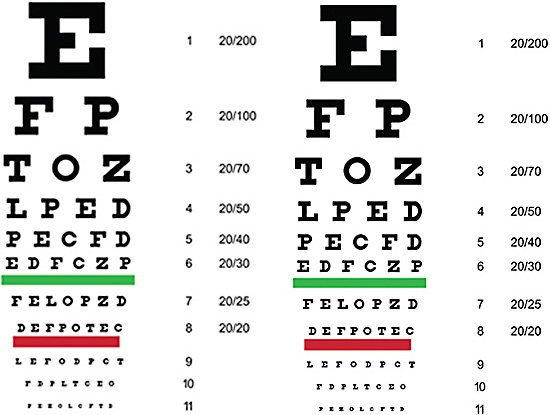 Figure 3. We need to ask the patient how sharp the 20/20 line is and work hard to achieve the crispness of the Snellen chart on the right for the happiest patients.
